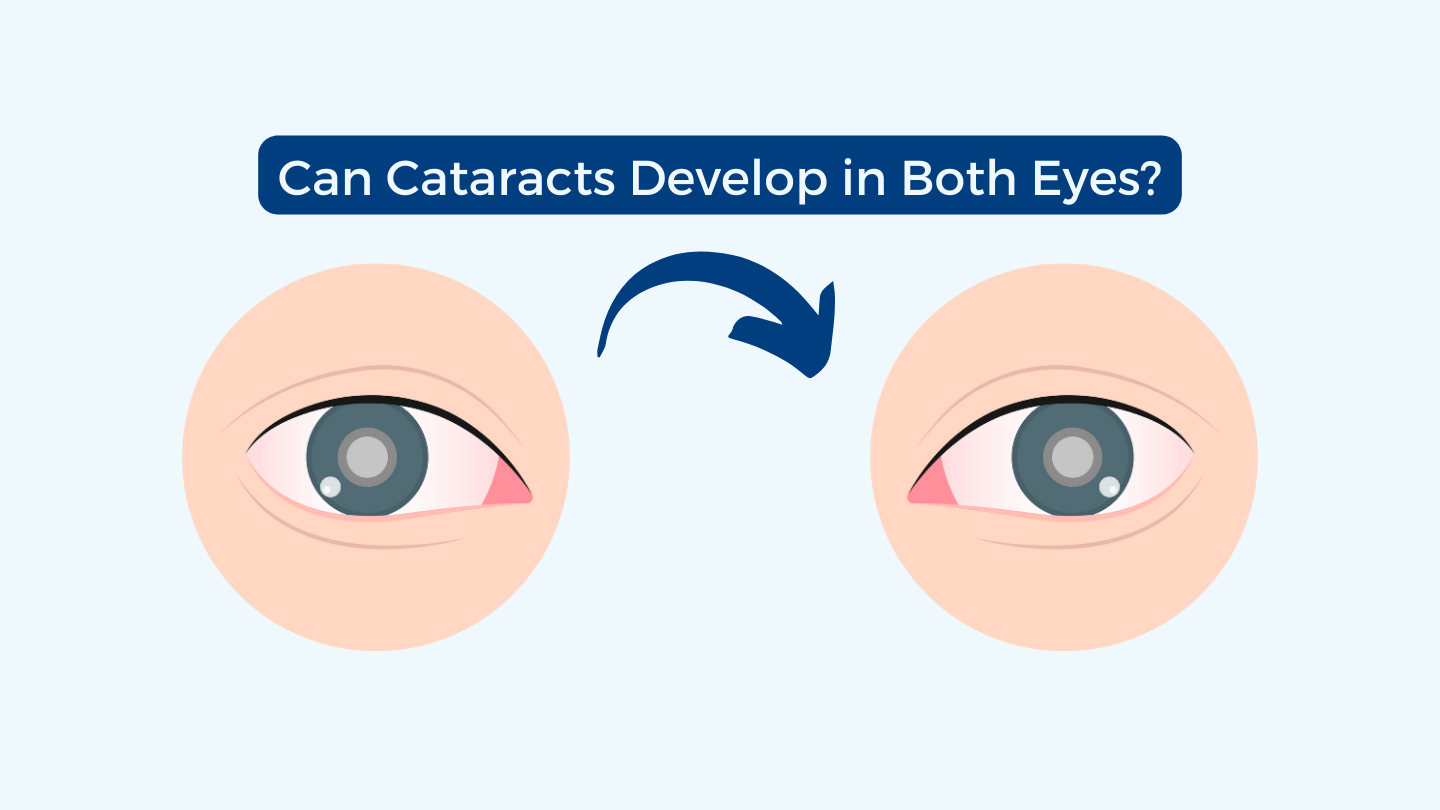 Can Cataracts Develop in Both Eyes? Free State Eye and Laser